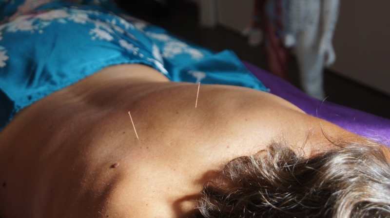 L’ACUPUNCTURE